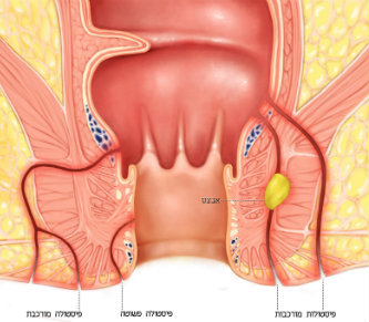 الناسور الشرجي (perianal fistulas) في داء كرون
