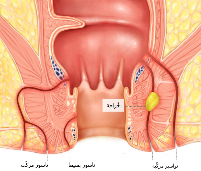 الناسور حول الشرج في مرض كرون